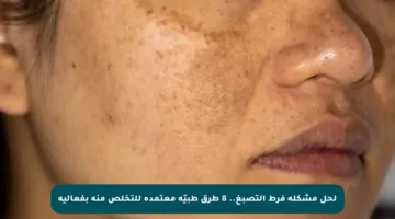 لحل مشكلة فرط التصبغ.. 8 طرق طبيّة معتمدة للتخلص منه بفعالية